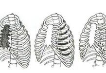Как лечат перелом ребер и грудины