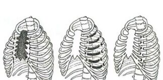 Как лечат перелом ребер и грудины