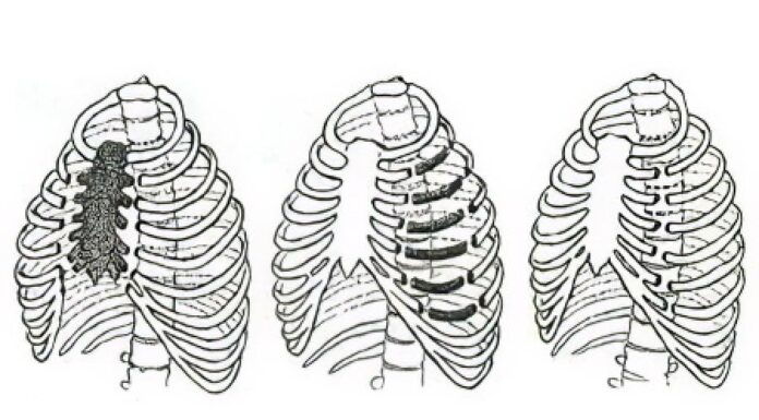 Как лечат перелом ребер и грудины